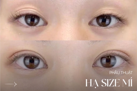 Phẫu Thuật Hạ Size Mí